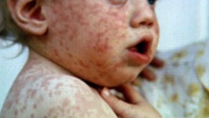 health-0326-measles-640x360
